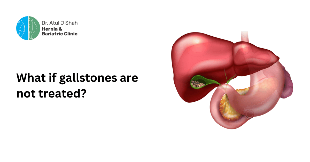 What if gallstones are not treated?